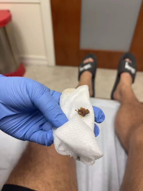 Thought I had swimmers ear, turns out…