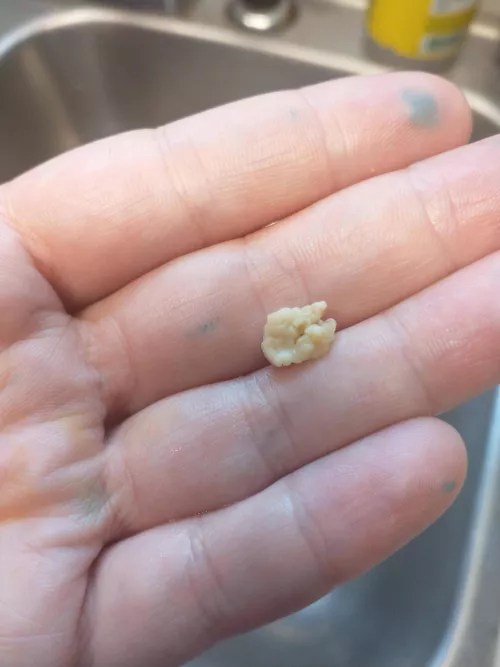 Tonsillectomy scheduled for next week!