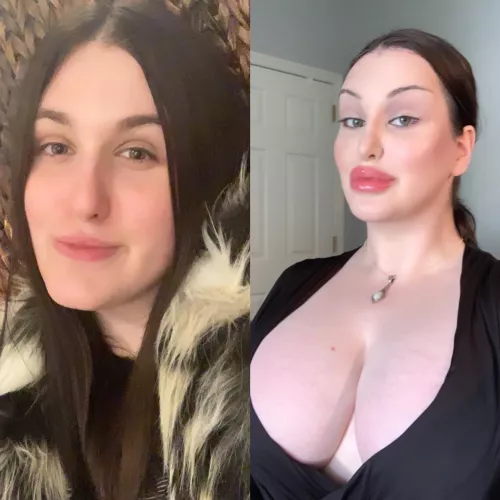 Trans Bmibo of The Year: 2020-2021 (Next Step 2,500cc+ Breast Expanders!)