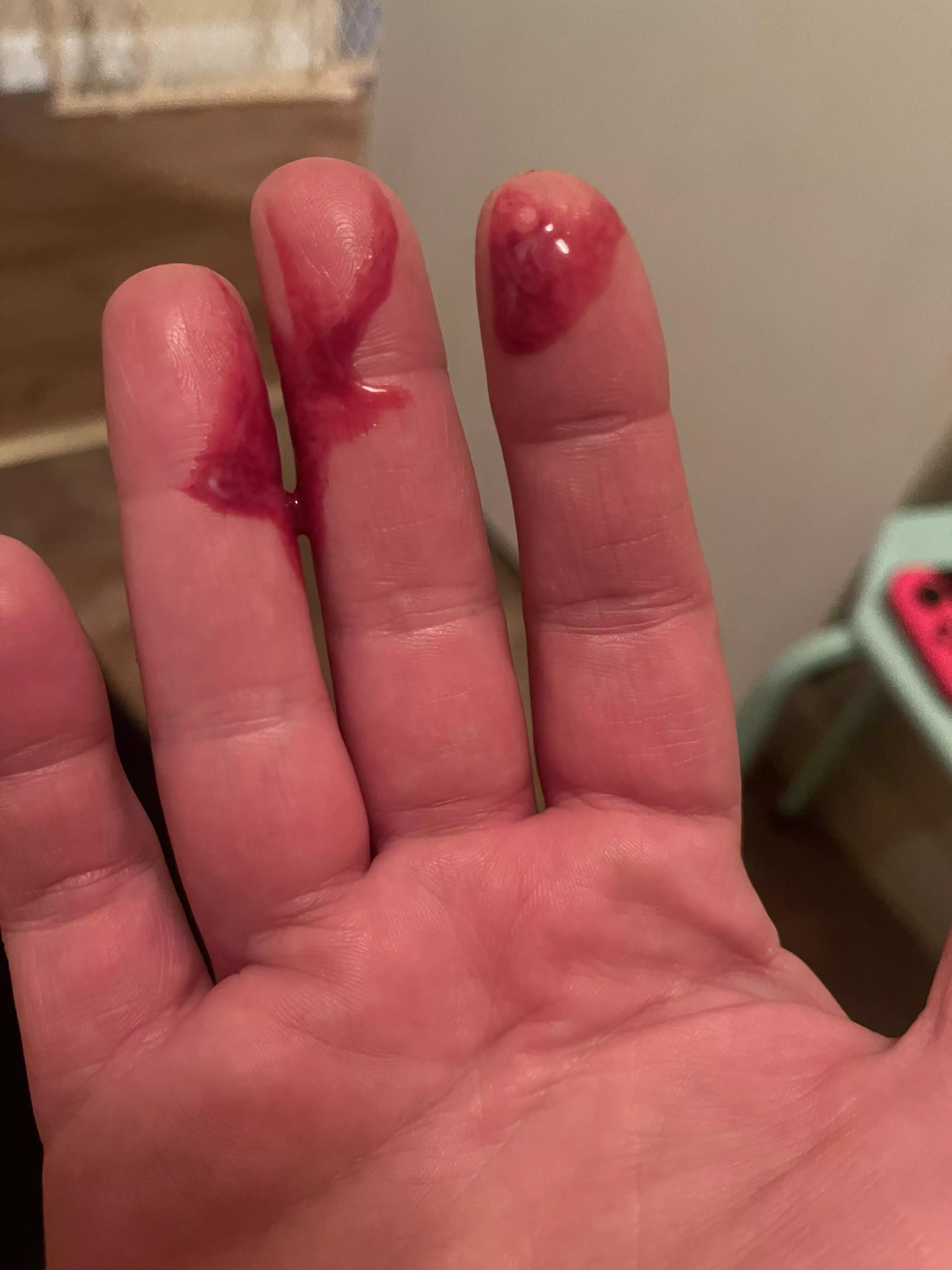 UGH that was painful. The aftermath of a armpit pop. It hurt for days, still feels full snd I can’t get anything else. I just couldn’t stand the pain anymore.