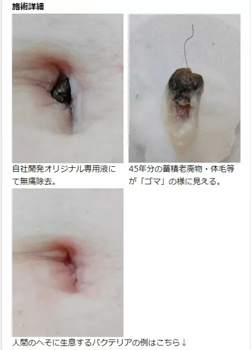 Umbolith Removal - Before and After Photos!