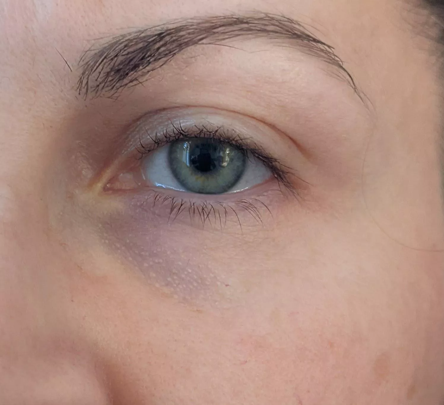 Under eye forbidden pops . Any ideas how to get rid of them safely?