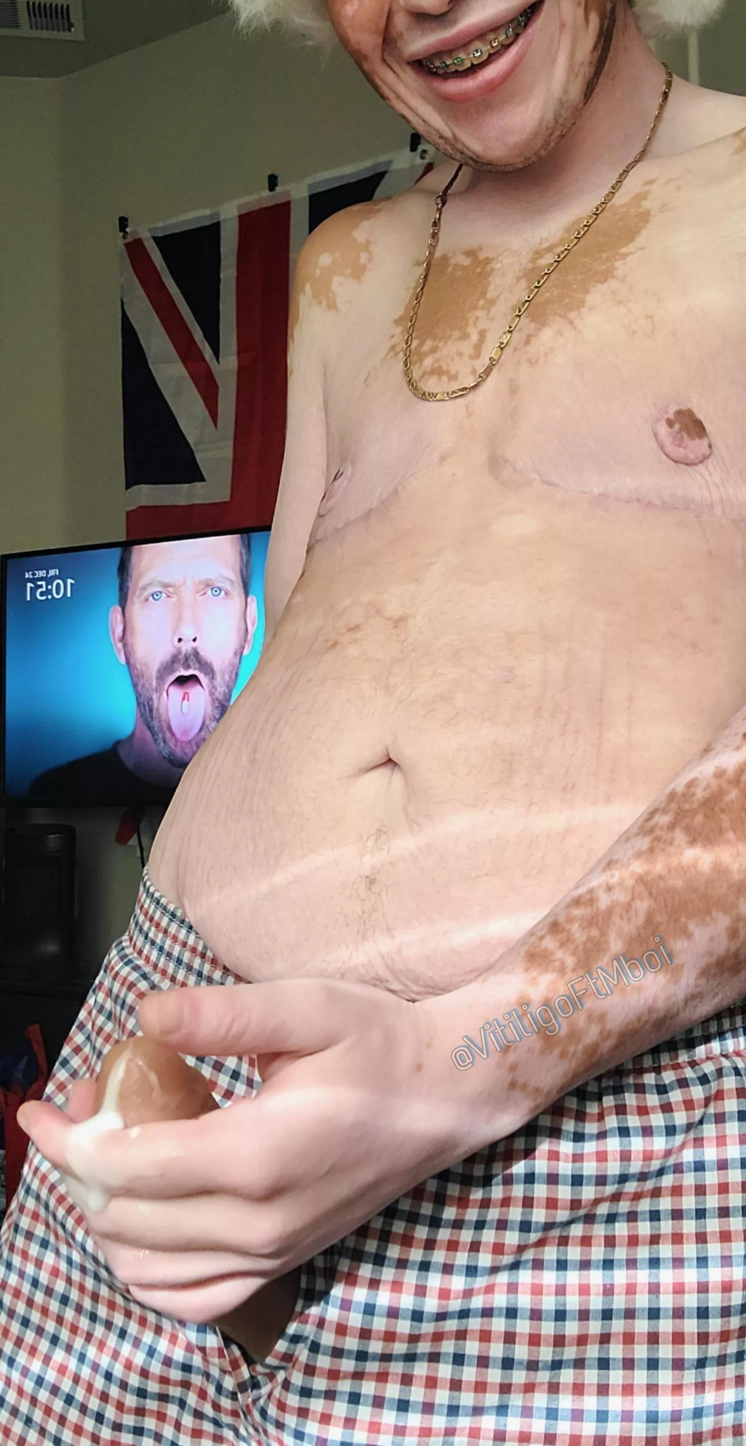 Vitiligo boi dripping