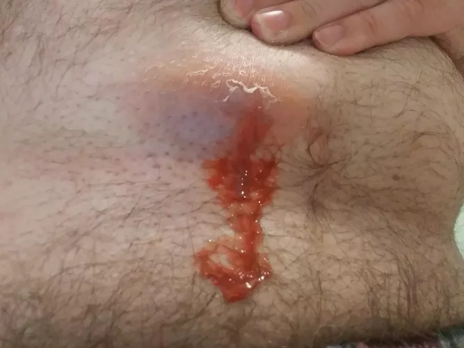 Week Old Abscess Starting to Drain - Presc Antibiotic