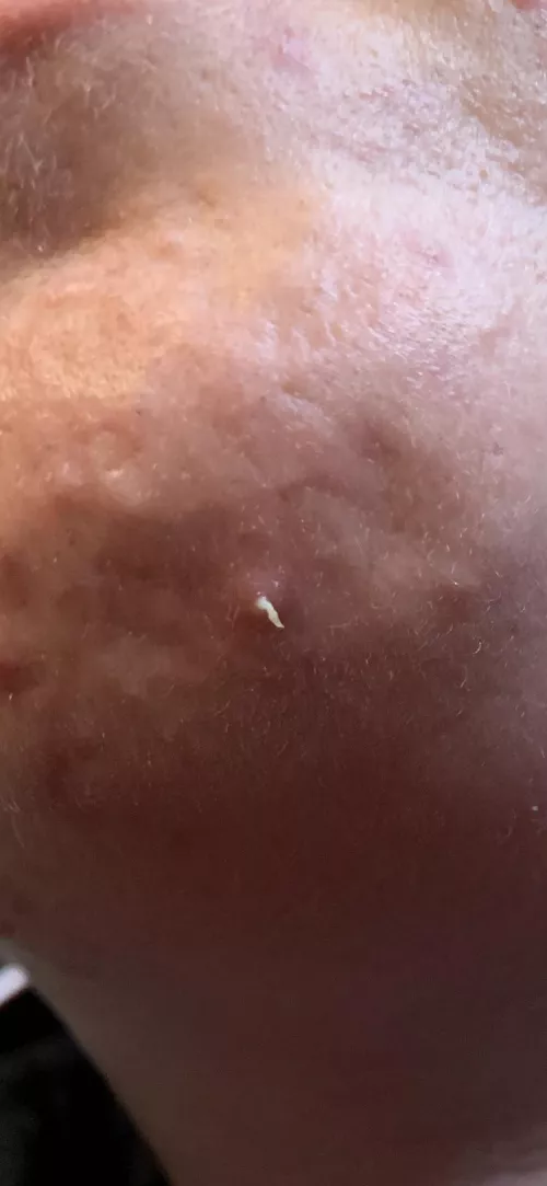 Weird pop on my chin