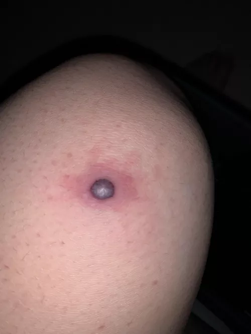 What is this? It’s like a blood filled pimple on my knee but I don’t know what could have caused it. What is this? It’s like a blood filled pimple on my knee but I don’t know what could have caused it.