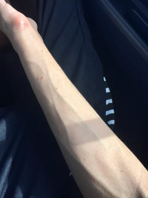 who loves forearms more: this sub or the mosquitoes that did this to me 🤕 who loves forearms more: this sub or the mosquitoes that did this to me 🤕